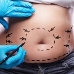 Circumferential Abdominoplasty Abu Dhabi 