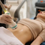 Laser Liposuction The Modern Solution for Sculpting Your Dream Body