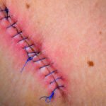 Suture Removal At Home in Dubai & Abu Dhabi 