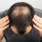 How to Care for Your Scalp After a Hair Transplant