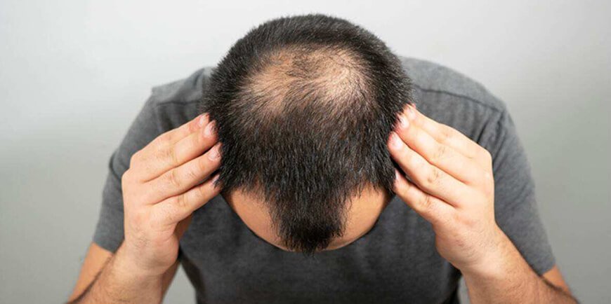 How to Care for Your Scalp After a Hair Transplant